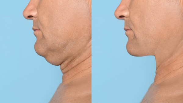 Which Non-Surgical Treatments Work Best for Jowls and Loose Skin Rushden?