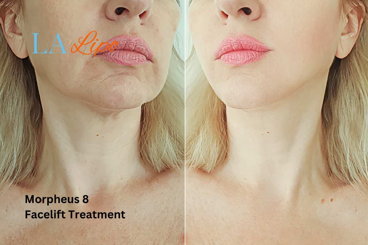 Turn back time with Morpheus8 Treatment Rushden