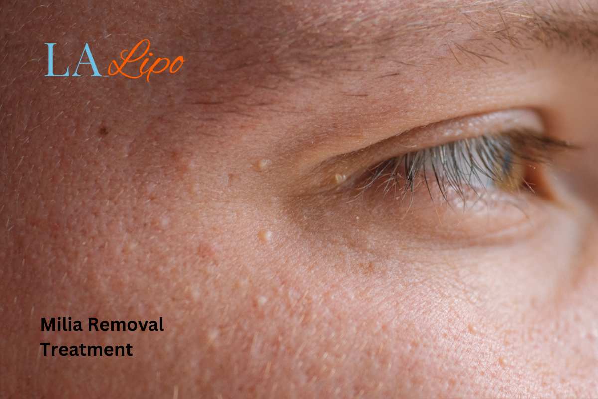 Cryopen Milia Removal: Is It the Easiest and Safest Option Rushden?