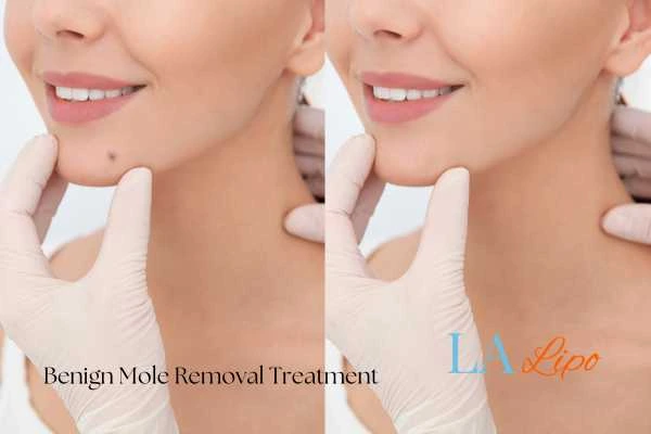 Before-and-after results following benign mole-removal treatment Rushden
