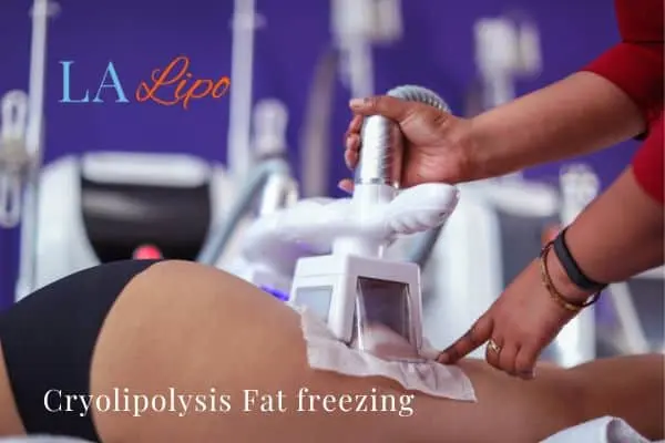 women getting fat freezing Rushden