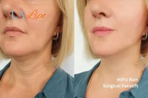 hi-fu for wrinkles Rushden before and after results