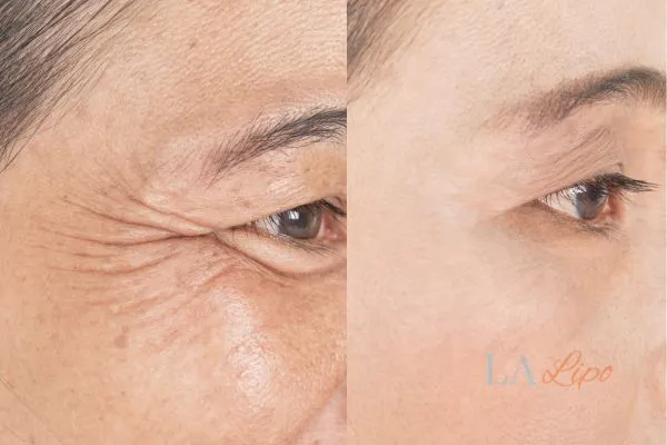 Before and after results of woman - HI-fu wrinkles reduction treatment Rushden