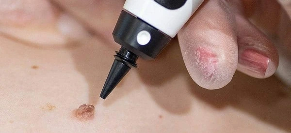 skin tag removal using cryopen Rushden