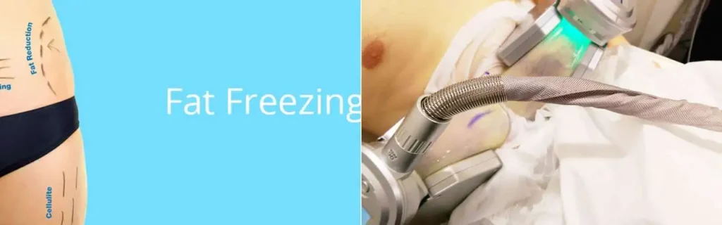 Fat freezing Rushden on multiple areas of the body