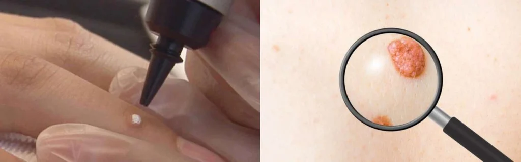 CryoPen practitioner Rushden assessing a benign mole before treatment