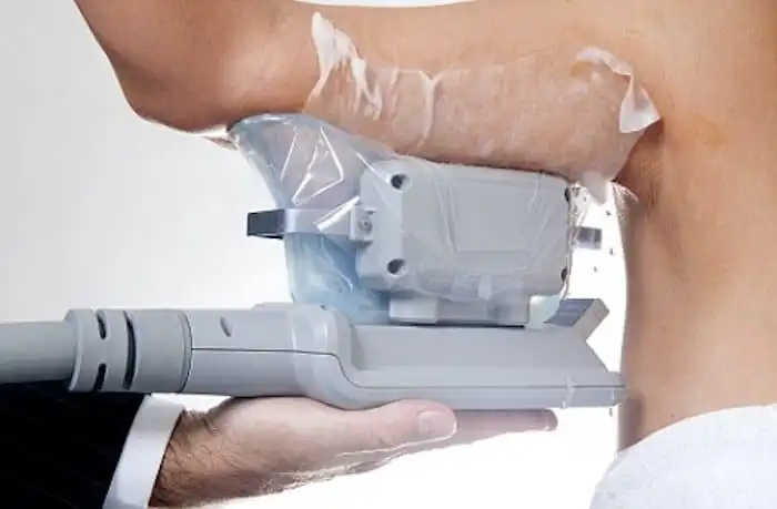 Picture of fat freezing Rushden on the upper arms.