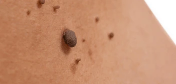 image of a skin tag Rushden