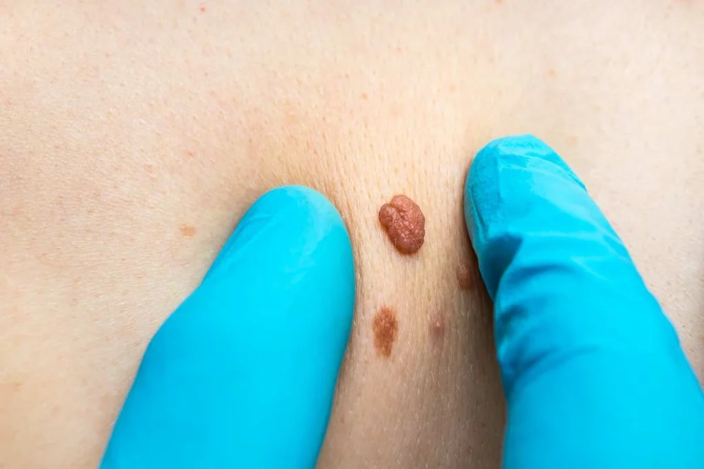 Consultant examining a skin tag Rushden