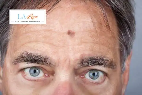 Solar Lentigo Removal Rushden image of man with mark on his forehead
