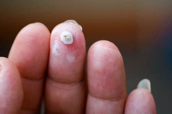 wart on person finger - cryotherapy to treat from LA LIPO Rushden