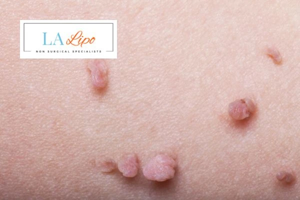 Does cryopen skin tag removal Rushden hurt? Find out now call our team today!
