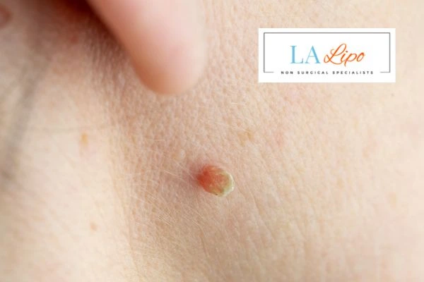 Book skin tag removal Rushden today speak to our team now!
