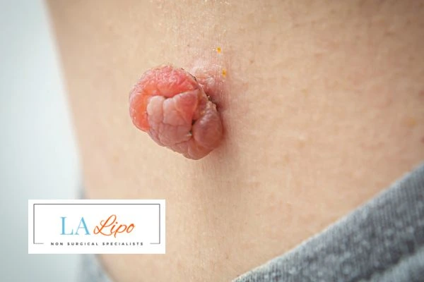 Interested in skin tag removal Rushden? Concerned about the pain? Find out more today!