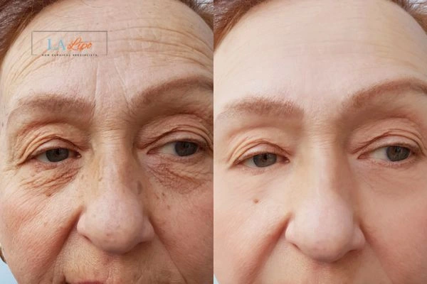The powerful benefits of Morpheus8 Treatment Rushden - Call Our team today!