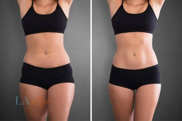 before and after results of non-surgical treatment to help a woman's body image and mental health Rushden