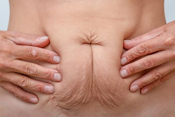 Should I Combine Diastasis Recti Treatment with Body Contouring for Better Results Rushden?