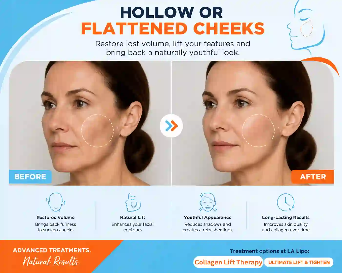 Sign #4: Hollow or Flattened Cheeks Rushden
